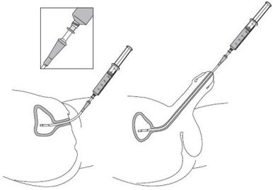 Instillation of a pharmacological solution in the urethra