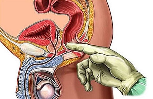 Prostate massage as a method to treat prostatitis
