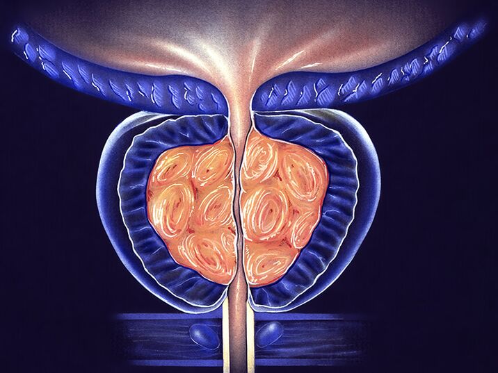 prevention of inflamed prostate and prostatitis