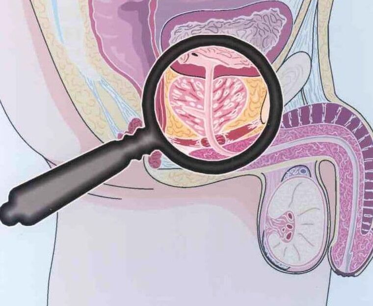 Defeat of prostate tissue in patients with chronic prostatitis men