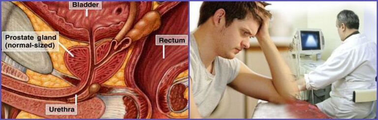 To diagnose chronic prostatitis in men, ultrasound of the prostate gland is performed. 